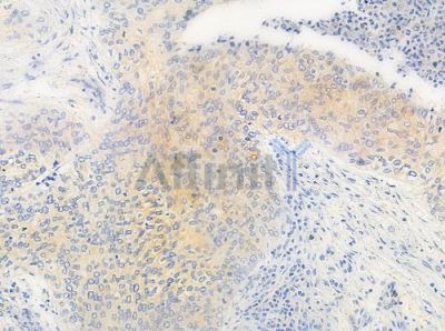 MAST4 Antibody - AF0731 at 1/100 staining human gastric carcinoma by IHC-P.