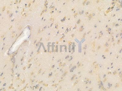 GRP94 Antibody - AF0735 at 1/100 staining human glioblastoma by IHC-P.