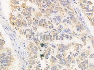 GRP94 Antibody - AF0735 at 1/100 staining human lung squamous cell carcinoma by IHC-P.