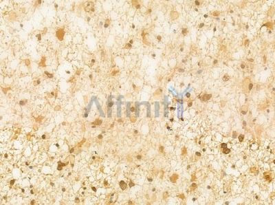 Hsp90 alpha Antibody - AF0774 at 1/100 staining human astrocytoma by IHC-P.