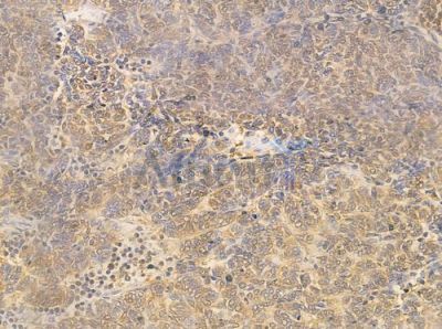 Hsp90 alpha Antibody - AF0774 at 1/100 staining human thymoma by IHC-P.
