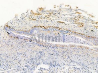 Cytokeratin 15 Antibody - AF0790 at 1/100 staining human lung squamous cell carcinoma by IHC-P.