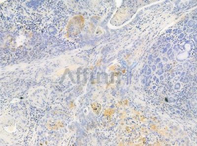 Cytokeratin 15 Antibody - AF0790 at 1/100 staining human esophageal carcinoma by IHC-P.