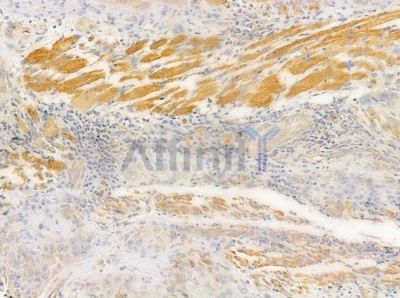 Syndecan 4 Antibody - AF0831 at 1/100 staining human tongue carcinoma by IHC-P.