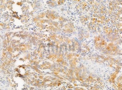 RPL31 Antibody - AF0854 at 1/100 staining human lung squamous cell carcinoma by IHC-P.
