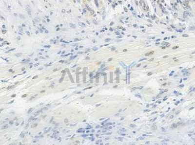 Acetyl-Histone H4 (Lys12) Antibody - AF1021 at 1/100 staining human tongue carcinoma by IHC-P.