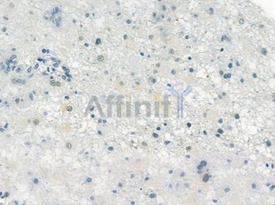 Phospho-DLGAP1 (Ser346) Antibody - AF2346 at 1/100 staining human astrocytoma by IHC-P.