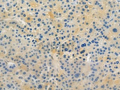 Phospho-KIF1B (Ser1487) Antibody - AF2357 at 1/100 staining human hepatocellular carcinoma by IHC-P.