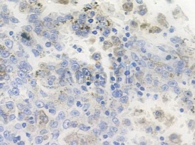 Phospho-Plastin L (Tyr28) Antibody - AF2360 at 1/100 staining human melanoma by IHC-P.