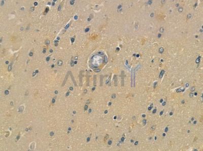 Phospho-PSD95 (Tyr236/Tyr240) Antibody - AF2391 at 1/100 staining human glioblastoma by IHC-P.