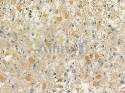 Phospho-PSD95 (Tyr236/Tyr240) Antibody - AF2391 at 1/100 staining human astrocytoma by IHC-P.