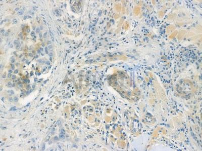 Phospho-RanBP3 (Ser126/Ser58) Antibody - AF2394 at 1/100 staining human tongue carcinoma by IHC-P.