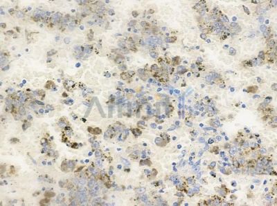 Phospho-Aurora A (Thr288) Antibody - AF3011 at 1/100 staining human melanoma by IHC-P.