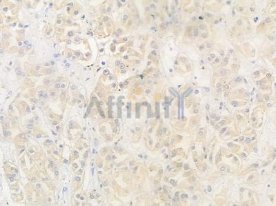 Phospho-JAK2 (Tyr1007) Antibody - AF3022 at 1/100 staining human renal cell carcinoma by IHC-P.