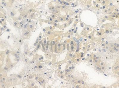 Phospho-MSK1 (Ser376) Antibody - AF3030 at 1/100 staining human renal cell carcinoma by IHC-P.