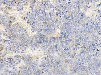 Phospho-EGFR (Thr669)[Tyr693] Antibody - AF3042 at 1/100 staining human melanoma by IHC-P.