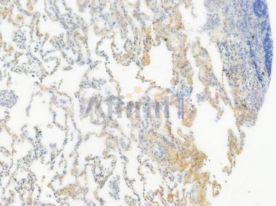 Phospho-EGFR (Ser1070) Antibody - AF3044 at 1/100 staining human small cell lung carcinoma by IHC-P.