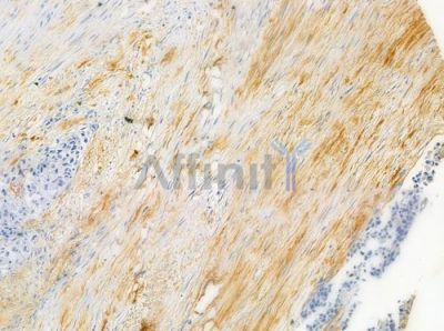 Phospho-EGFR (Ser1070) Antibody - AF3044 at 1/100 staining human prostate carcinoma by IHC-P.