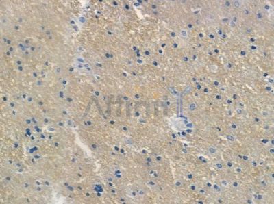 Phospho-EGFR (Tyr1048)[Tyr1172] Antibody - AF3047 at 1/100 staining human glioblastoma by IHC-P.