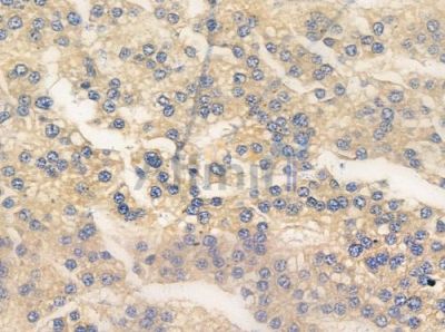 Phospho-Estrogen Receptor alpha (Tyr537) Antibody - AF3058 at 1/100 staining human hepatocellular carcinoma by IHC-P.