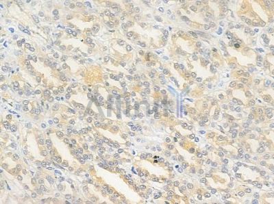 Phospho-Estrogen Receptor alpha (Ser106) Antibody - AF3060 at 1/100 staining human renal cell carcinoma by IHC-P.
