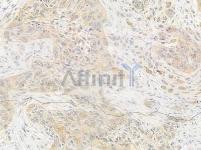 Phospho-Estrogen Receptor alpha (Ser106) Antibody - AF3060 at 1/100 staining human tongue carcinoma by IHC-P.