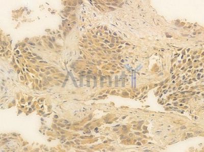 Phospho-C-RAF (Ser259) Antibody - AF3064 at 1/100 staining human lung squamous cell carcinoma by IHC-P.