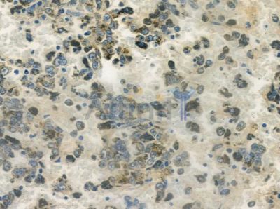 Phospho-p53 (Ser46) Antibody - AF3076 at 1/100 staining human melanoma by IHC-P.