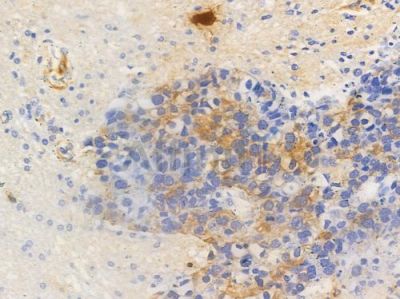 Phospho-HSP27 (Ser15) Antibody - AF3080 at 1/100 staining human glioblastoma by IHC-P.