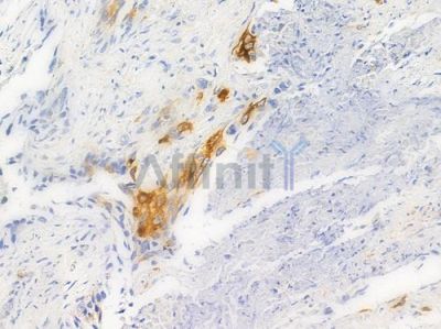 Phospho-HSP27 (Ser15) Antibody - AF3080 at 1/100 staining human lung squamous cell carcinoma by IHC-P.