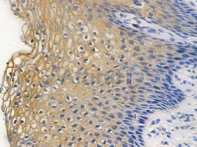 Phospho-HSP27 (Ser82) Antibody - AF3082 at 1/100 staining human cervical carcinoma by IHC-P.