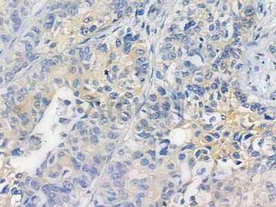 Phospho-Integrin beta3 (Tyr773) Antibody - AF3085 at 1/100 staining human lung squamous cell carcinoma by IHC-P.