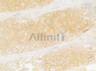 Phospho-Insulin Receptor (Tyr1355) Antibody - AF3098 at 1/100 staining human prostate carcinoma by IHC-P.