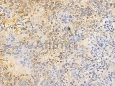 Phospho-Retinoblastoma (Ser795) Antibody - AF3104 at 1/100 staining human thymoma by IHC-P.
