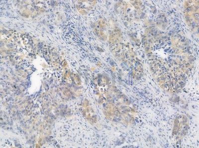 Phospho-eIF4E (Ser209) Antibody - AF3110 at 1/100 staining human lung squamous cell carcinoma by IHC-P.