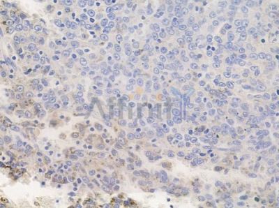 Phospho-PDGF Receptor beta (Tyr771) Antibody - AF3134 at 1/100 staining human melanoma by IHC-P.