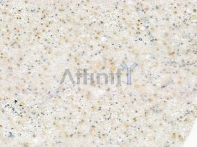 Phospho-Bcl-2 (Ser87) Antibody - AF3138 at 1/100 staining human astrocytoma by IHC-P.