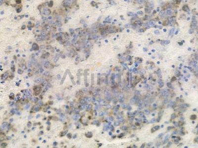 Phospho-FGFR1 (Tyr766) Antibody - AF3156 at 1/100 staining human melanoma by IHC-P.