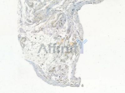 Phospho-SRF (Ser99)[Ser103] Antibody - AF3160 at 1/100 staining human testicular cancer by IHC-P.