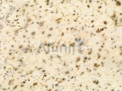 Phospho-Cyclin B1 (Ser126) Antibody - AF3168 at 1/100 staining human melanoma by IHC-P.