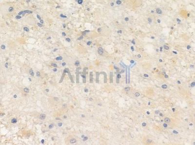 Phospho-Ezrin (Thr567) Antibody - AF3172 at 1/100 staining human astrocytoma by IHC-P.