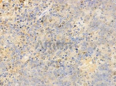 Phospho-ATF2 (Ser62/Ser44) Antibody - AF3176 at 1/100 staining human melanoma by IHC-P.