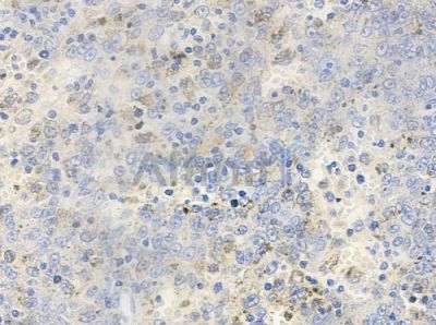Phospho-VAV1 (Tyr174) Antibody - AF3182 at 1/100 staining human melanoma by IHC-P.