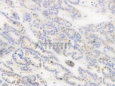 Phospho-RPA32/RPA2 (Thr21) Antibody - AF3183 at 1/100 staining human renal cell carcinoma by IHC-P.
