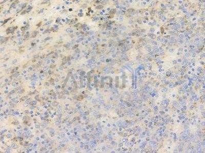 Phospho-PLCG2 (Tyr753) Antibody - AF3192 at 1/100 staining human melanoma by IHC-P.