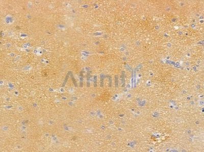 Phospho-Stathmin 1 (Ser38) Antibody - AF3195 at 1/100 staining human glioblastoma by IHC-P.