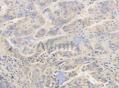 Phospho-PKC alpha (Thr638) Antibody - AF3196 at 1/100 staining human lung adenocarcinoma by IHC-P.