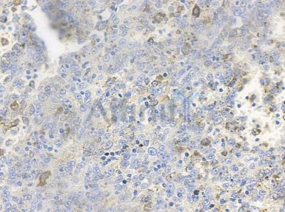 Phospho-IGFBP3 (Ser183) Antibody - AF3203 at 1/100 staining human melanoma by IHC-P.