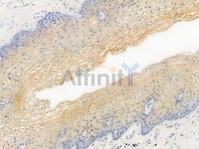 Phospho-PTP1B (Ser50) Antibody - AF3205 at 1/100 staining human cervical carcinoma by IHC-P.