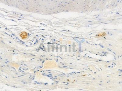 Phospho-ELK1 (Ser383) Antibody - AF3212 at 1/100 staining human testicular cancer by IHC-P.